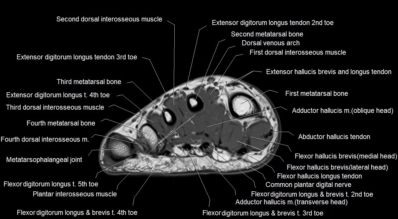 MRI 3T foot axial cross sectional anatomy image 23.webp